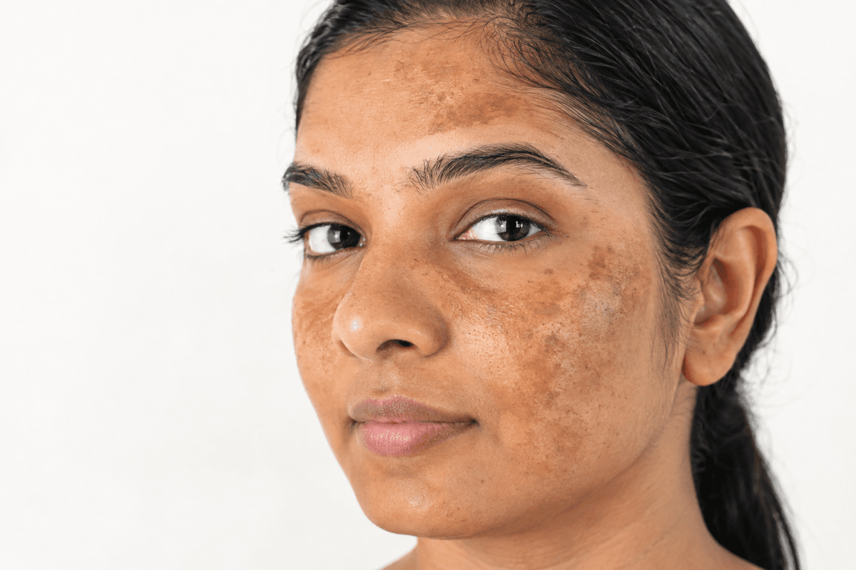Pigmentation