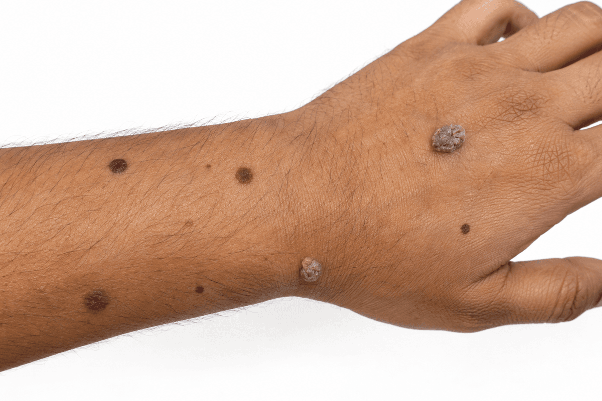 Moles and Warts