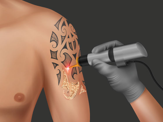 Laser Tattoo removal clinic- get rid of un wanted tattoos